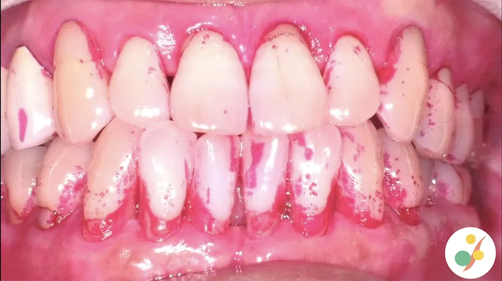 PCR歯周病の原因となる歯垢の磨き残しを、染め出し液を使いながら確認する検査