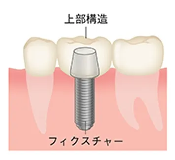 インプラント