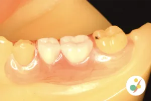 ノンクラスプデンチャー