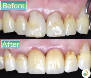 ラレミネートべニア