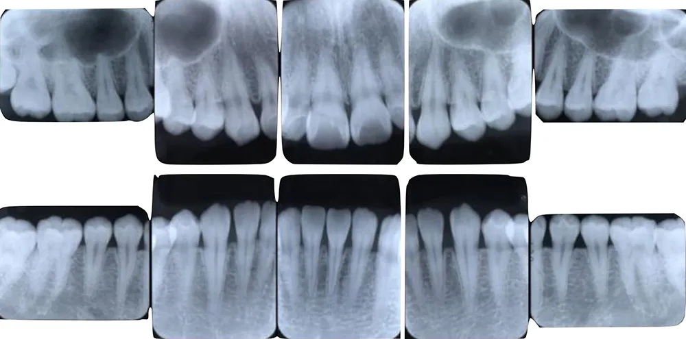 レントゲン写真