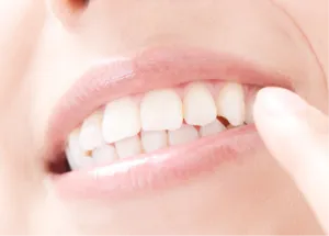 ホワイトニング