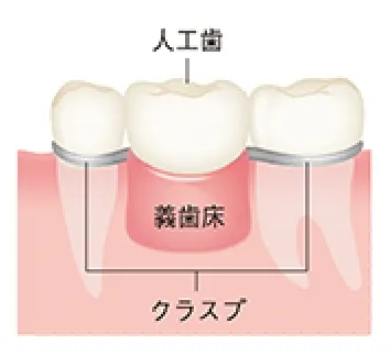 入れ歯（義歯）