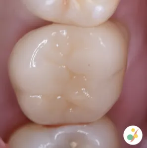 オールセラミック ジルコニアクラウン 被せ物